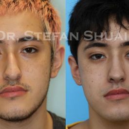 male patient before and after Rhinoplasty