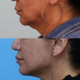 female patient before and after Facial Rejuvenation