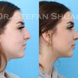 female patient before and after Rhinoplasty