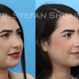 female patient before and after Rhinoplasty