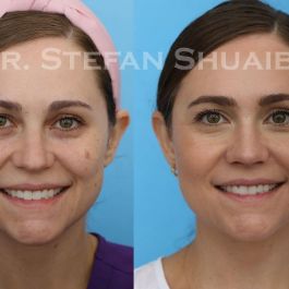 female patient before and after Facial Rejuvenation