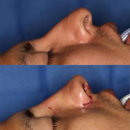 male patient before and after Rhinoplasty