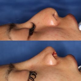 female patient before and after Rhinoplasty