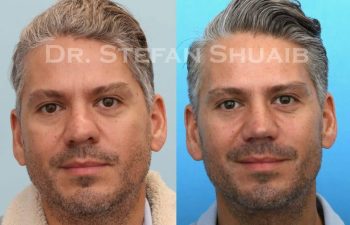 male patient before and after Rhinoplasty