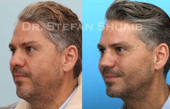 male patient before and after Rhinoplasty