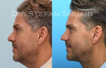 male patient before and after Rhinoplasty