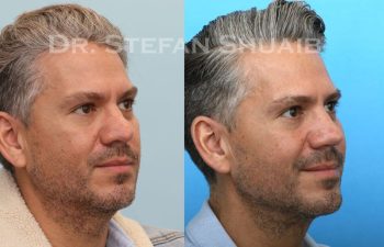 male patient before and after Rhinoplasty