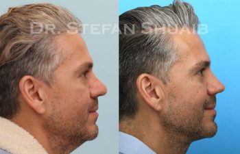 male patient before and after Rhinoplasty