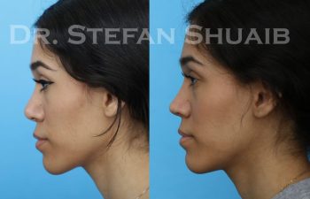 female patient before and after revision rhinoplasty