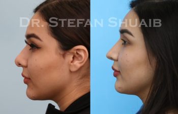 female patient before and after revision rhinoplasty