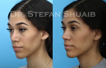 female patient before and after revision rhinoplasty