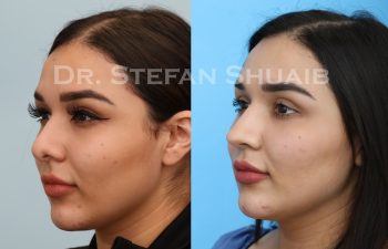 female patient before and after revision rhinoplasty