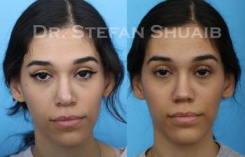 female patient before and after revision rhinoplasty