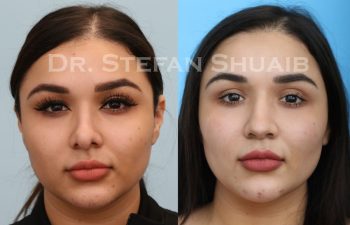 female patient before and after revision rhinoplasty