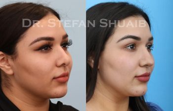 female patient before and after revision rhinoplasty