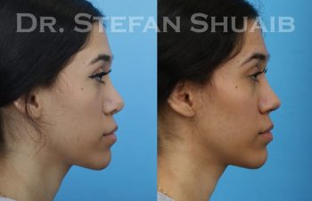 female patient before and after revision rhinoplasty