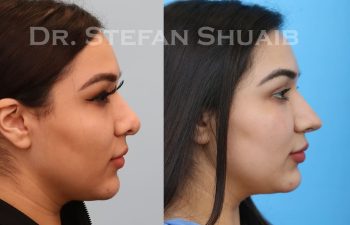 female patient before and after revision rhinoplasty