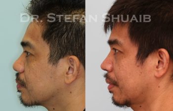 male patient before and after asian rhinoplasty