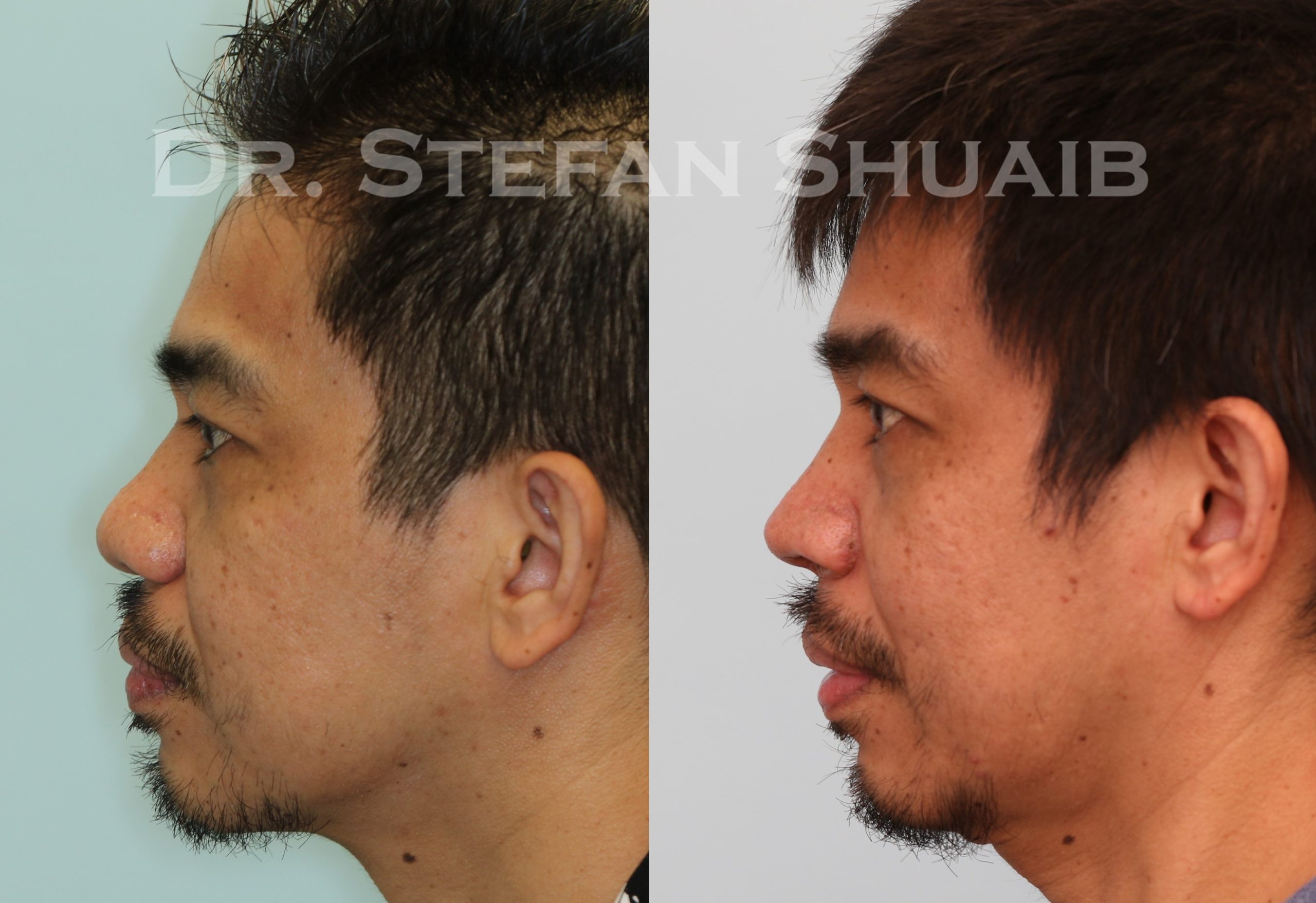 male patient before and after asian rhinoplasty