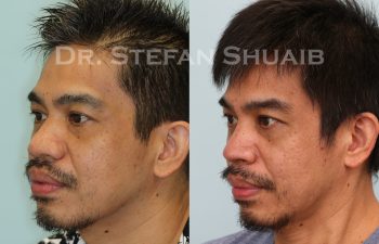 male patient before and after asian rhinoplasty