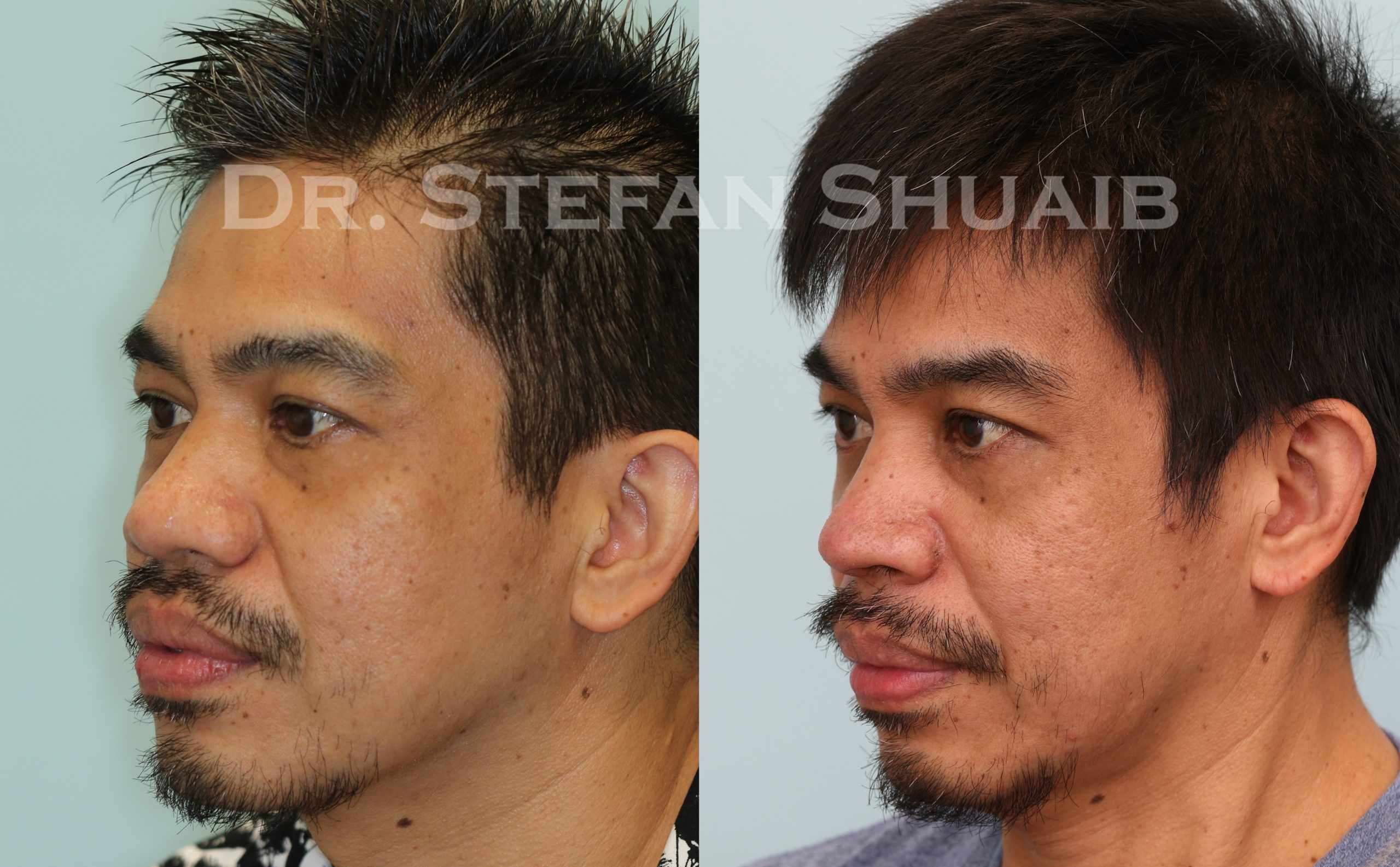 male patient before and after asian rhinoplasty