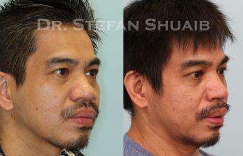 male patient before and after asian rhinoplasty