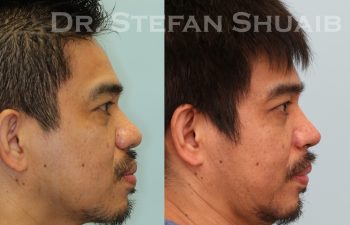 male patient before and after asian rhinoplasty