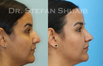 female patient before and after Rhinoplasty