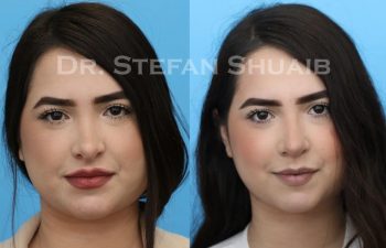 female patient before and after revision rhinoplasty