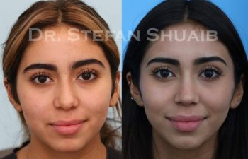 female patient before and after Rhinoplasty