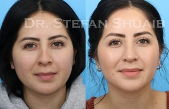 female patient before and after Rhinoplasty