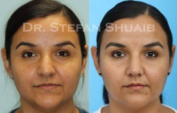 female patient before and after Rhinoplasty