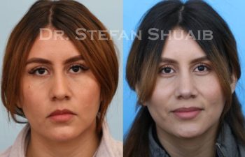 female patient before and after Rhinoplasty