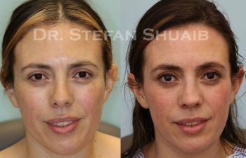 female patient before and after Rhinoplasty