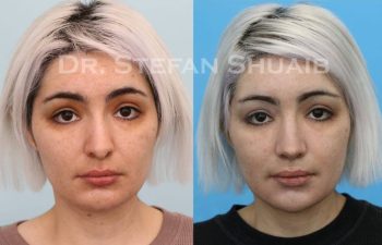 female patient before and after Rhinoplasty