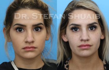 female patient before and after Rhinoplasty