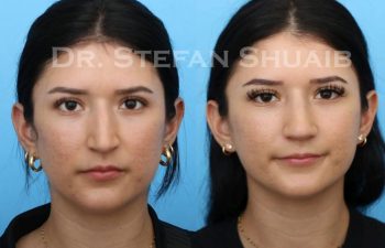 female patient before and after Rhinoplasty