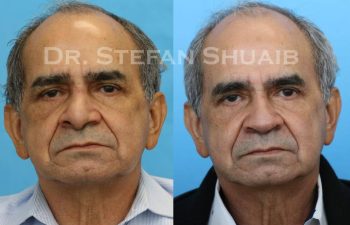 male patient before and after Rhinoplasty