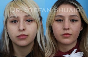 female patient before and after Rhinoplasty