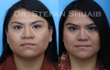 female patient before and after Rhinoplasty