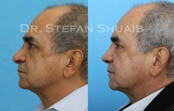 male patient before and after Rhinoplasty