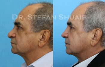 male patient before and after Rhinoplasty