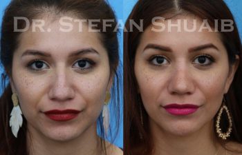 female patient before and after Rhinoplasty