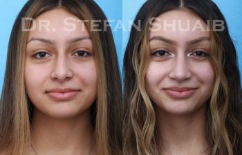 female patient before and after Rhinoplasty