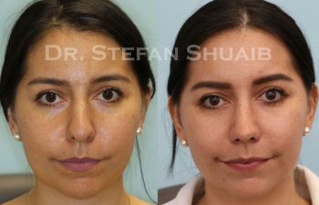 female patient before and after Rhinoplasty