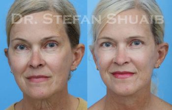 female patient before and after Facial Rejuvenation