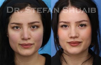 female patient before and after revision rhinoplasty