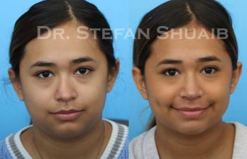 female patient before and after revision rhinoplasty