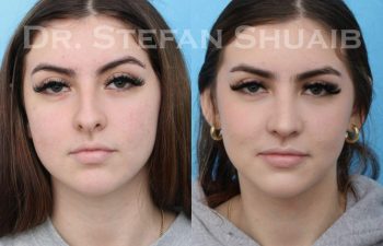 female patient before and after Rhinoplasty