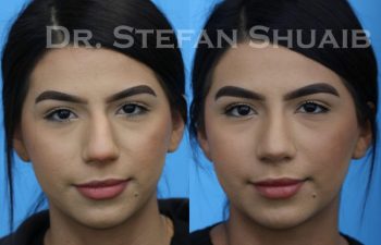 female patient before and after Rhinoplasty